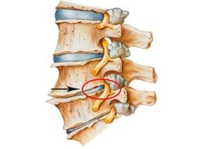 Oznaki i objawy osteochondozy