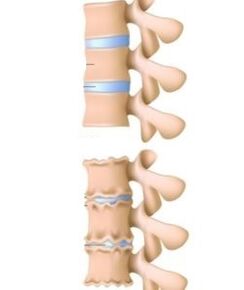 Przyczyny osteochondrozy