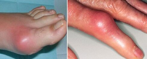 pojawienie się stawów z zapaleniem stawów