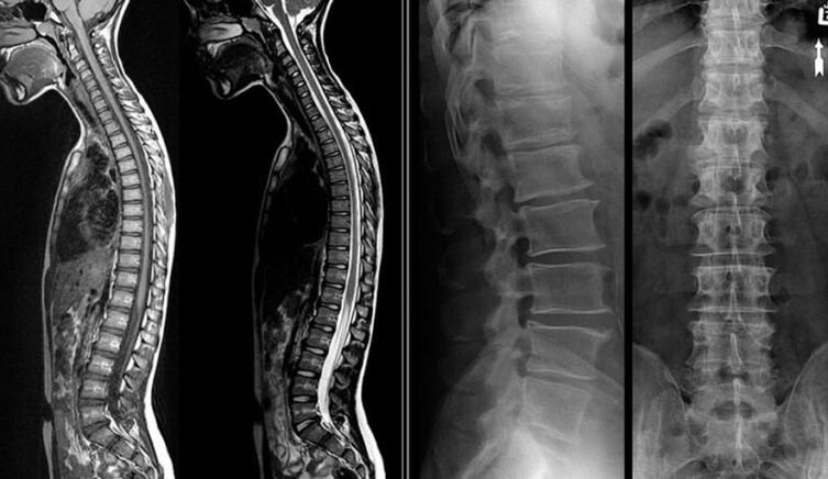 Zdjęcia rentgenowskie i MRI dla osteochondrozy