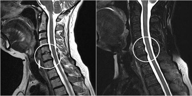 MRI kręgosłupa szyjnego z objawami osteochondrozy