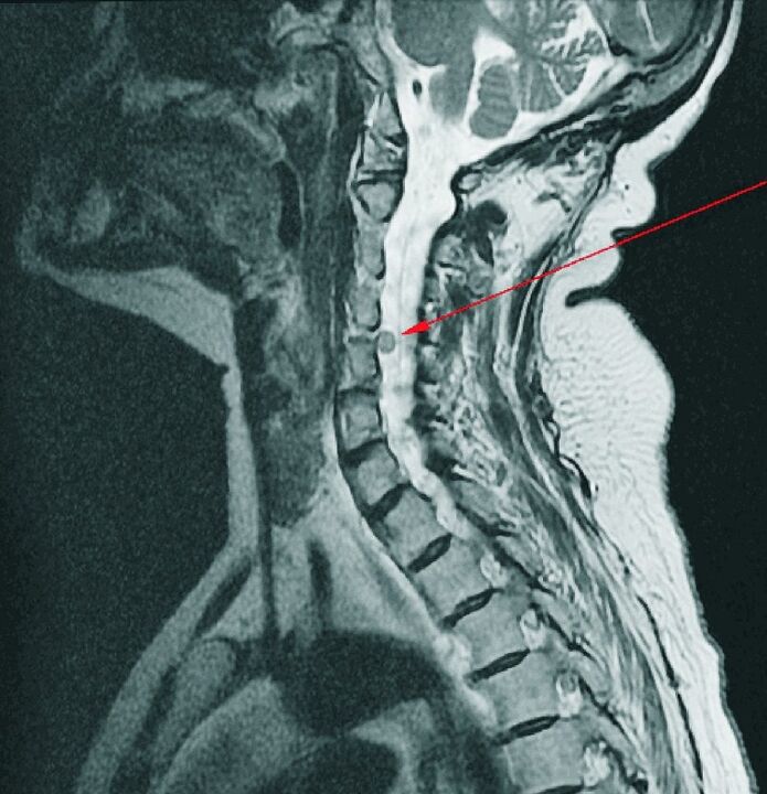 Przepuklina międzykręgowa odcinka szyjnego kręgosłupa na MRI