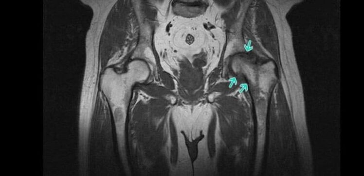 Zmiany zwyrodnieniowe-dystroficzne w stawie biodrowym w badaniu MRI