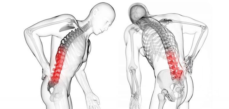 powikłania osteochondrozy szyjnej